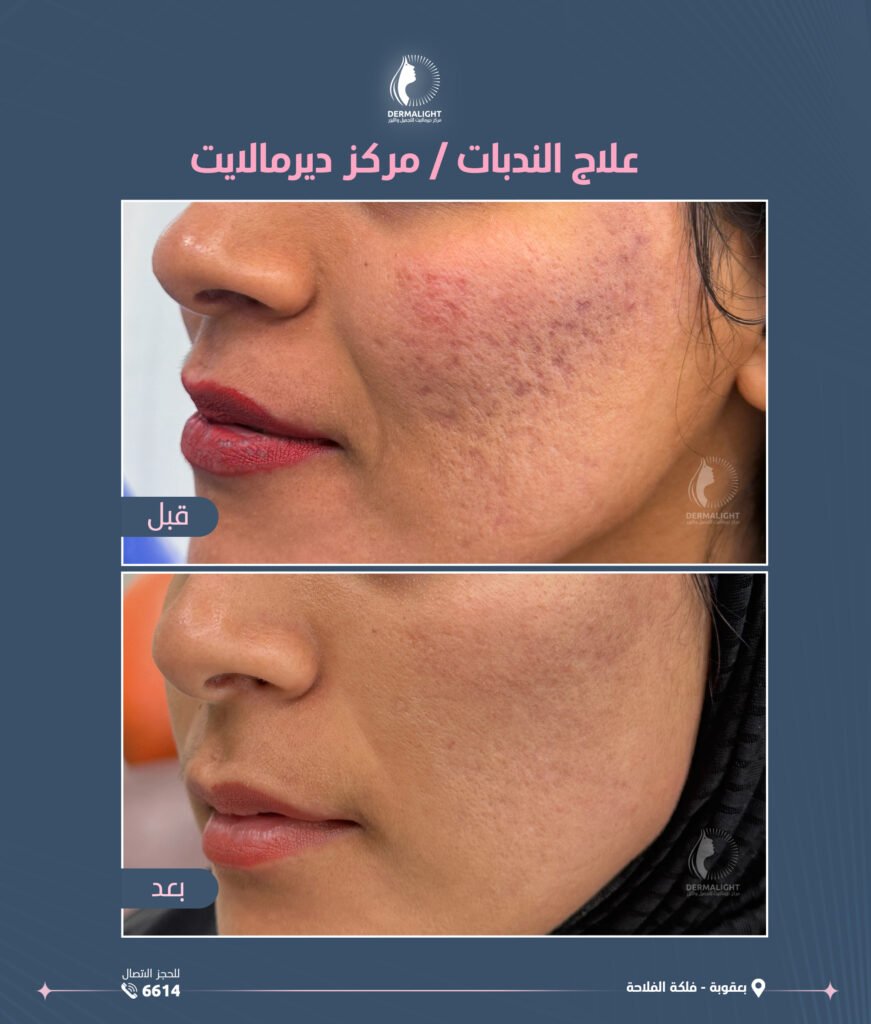 بوست قبل وبعد علاج الندبات 00